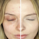 A Student's Guide to Dealing With Acne