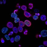 Pioneering new cancer treatment developed at Newcastle offers hope to patients