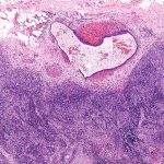 Endometriosis Lymph Node